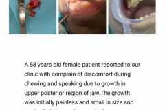 surgery-apollo-drdo-dental