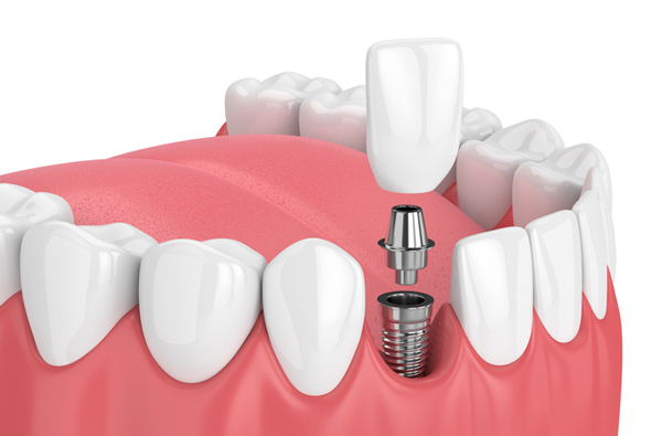 dental-implant.