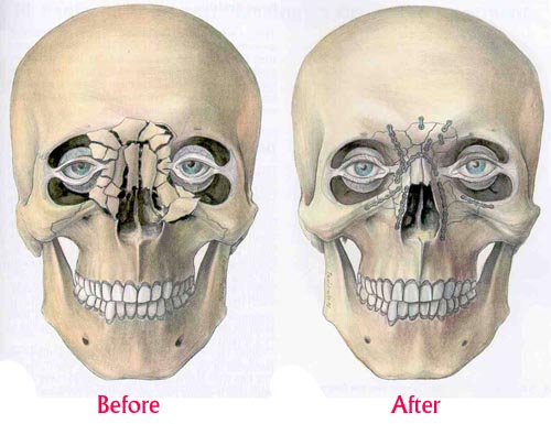 facial-fractures